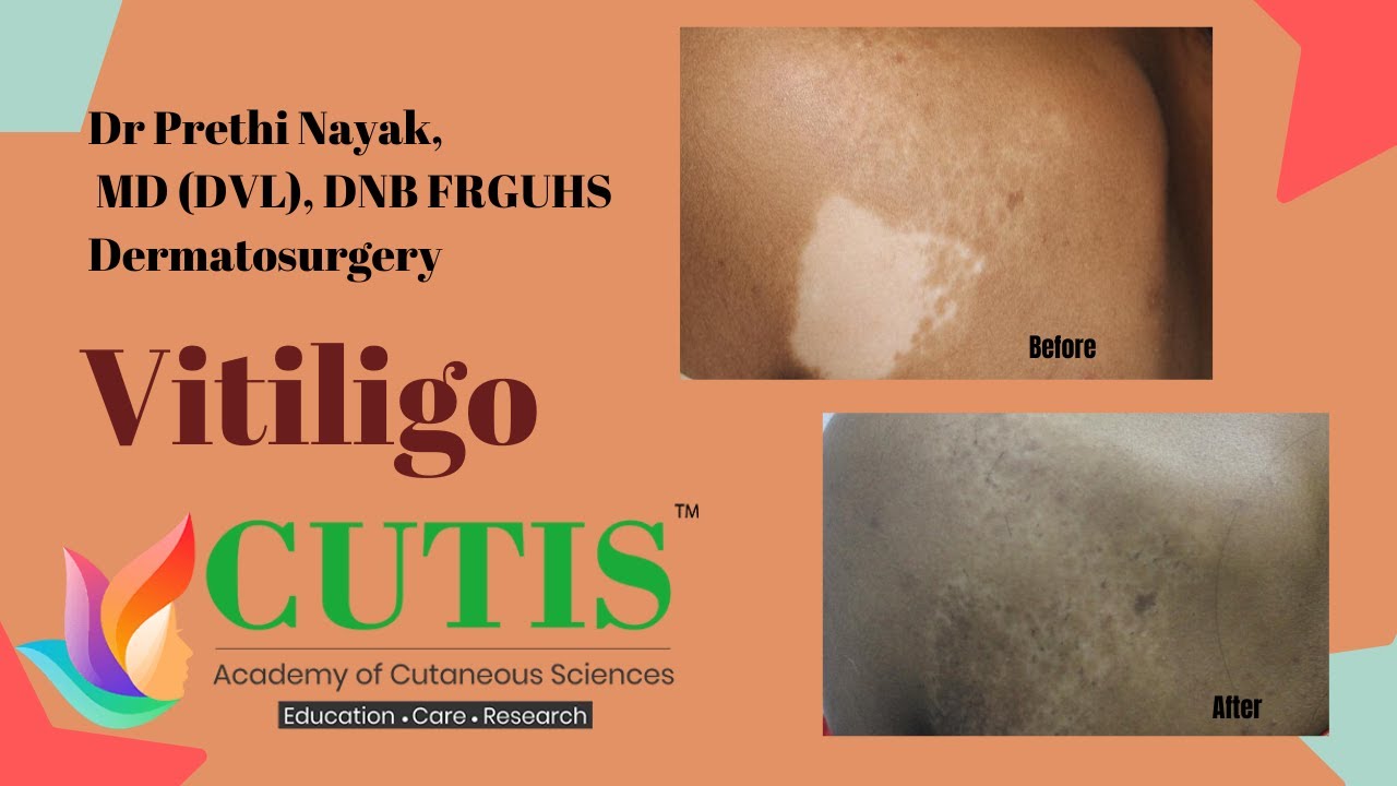 White spots on skin - Vitiligo : Myths, Symptoms & Treatments