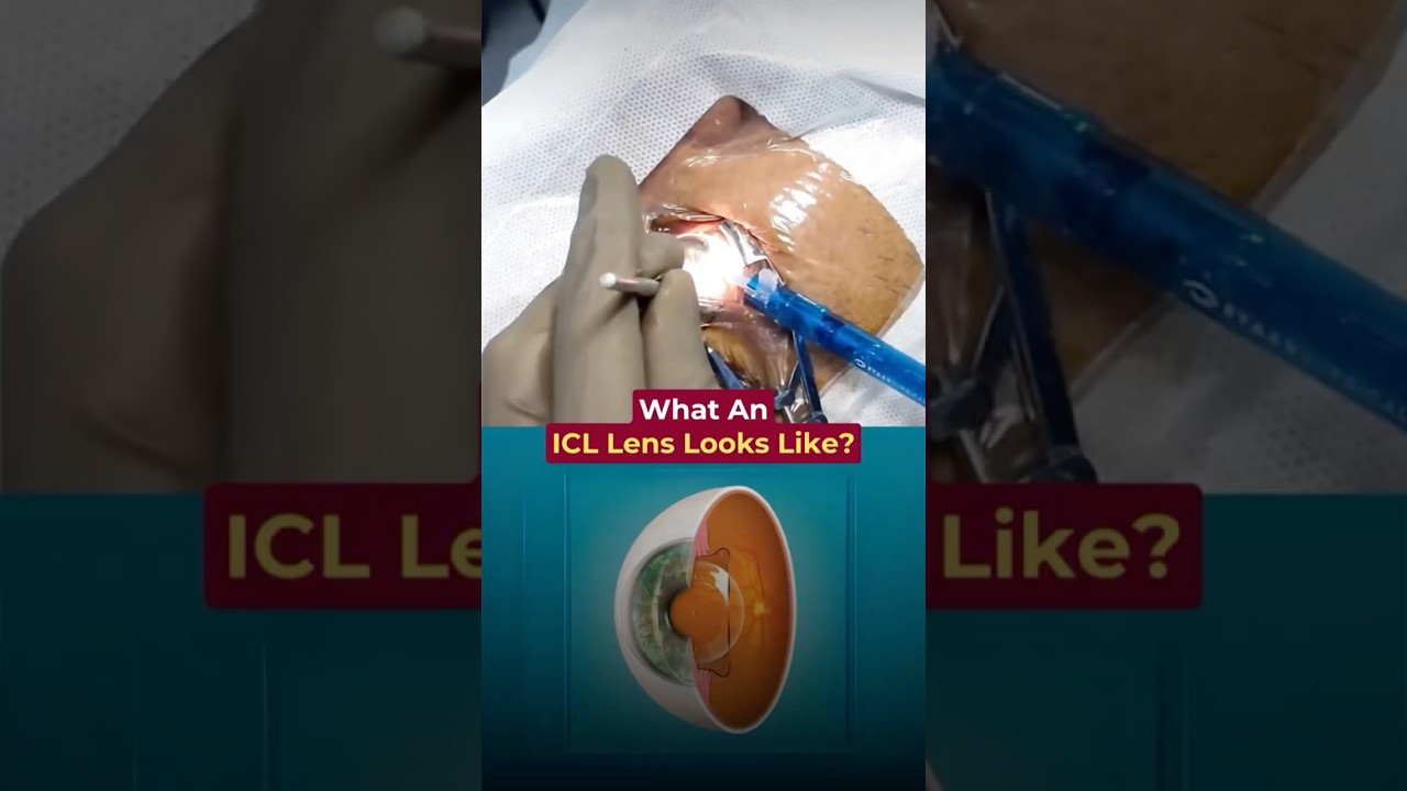What an ICL lens looks like? - Dr. Advaith Sai Alampur | Envision LASIK Centre
