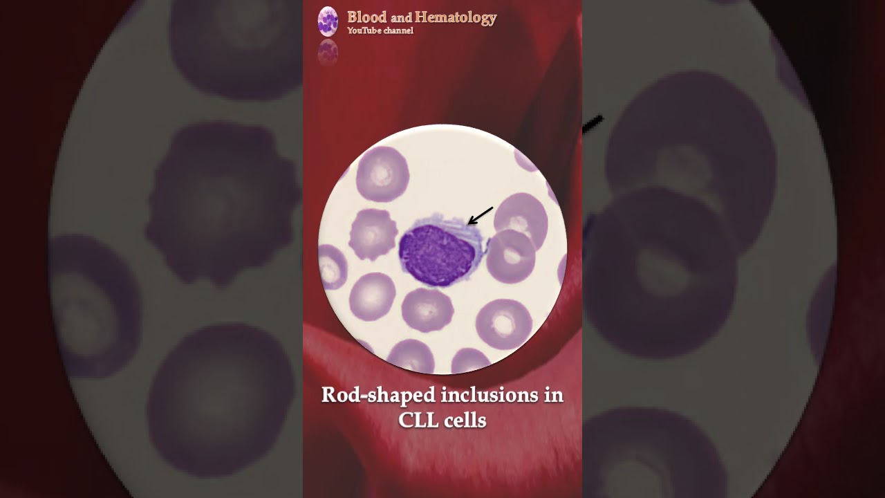 Rod-shaped inclusions in CLL cells
