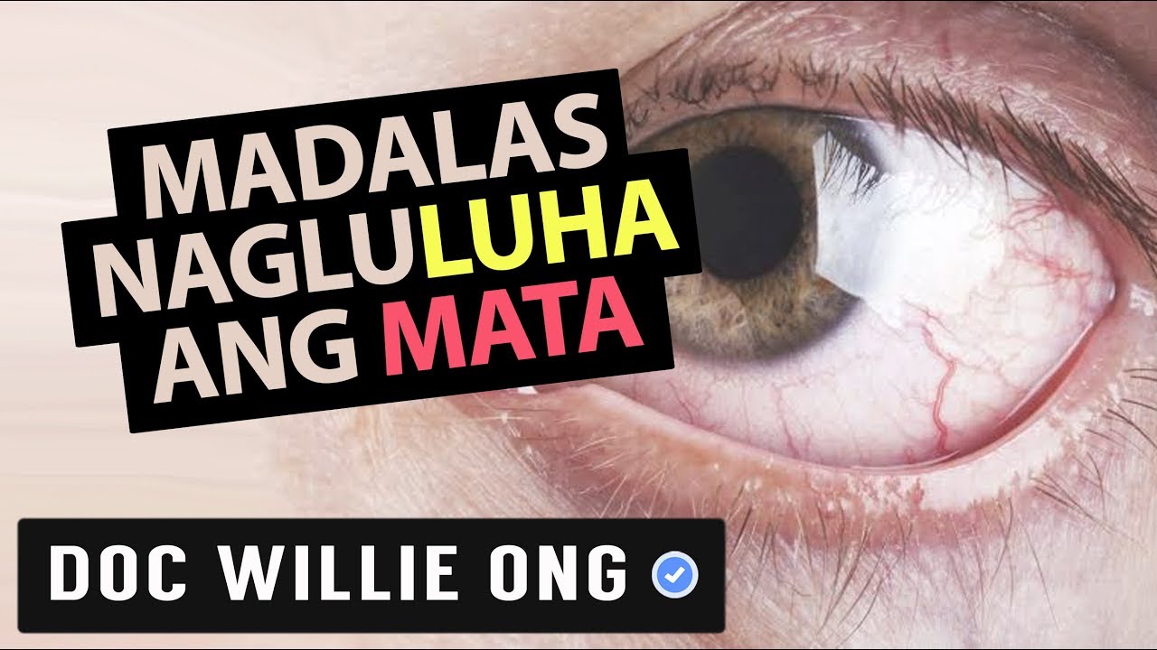 Madalas Nag-LULUHA ang MATA - ni Doc Yul Dorotheo (Eye Doctor) #2b