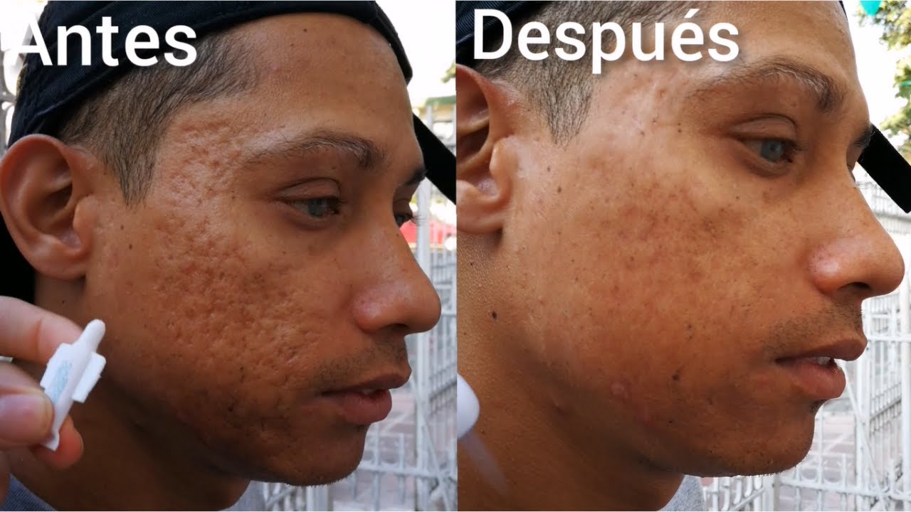🤩 ELIMINA LAS CICATRICES DE ACNE EN TAN SOLO 2 MINUTOS CON INSTANTLY AGELESS | Demostraci&oacute;n en vivo