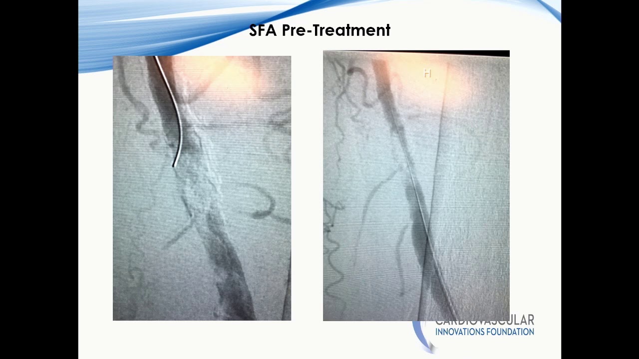 Phoenix Atherectomy – Why, When, and How? - Mehdi H. Shishehbor, DO, PhD