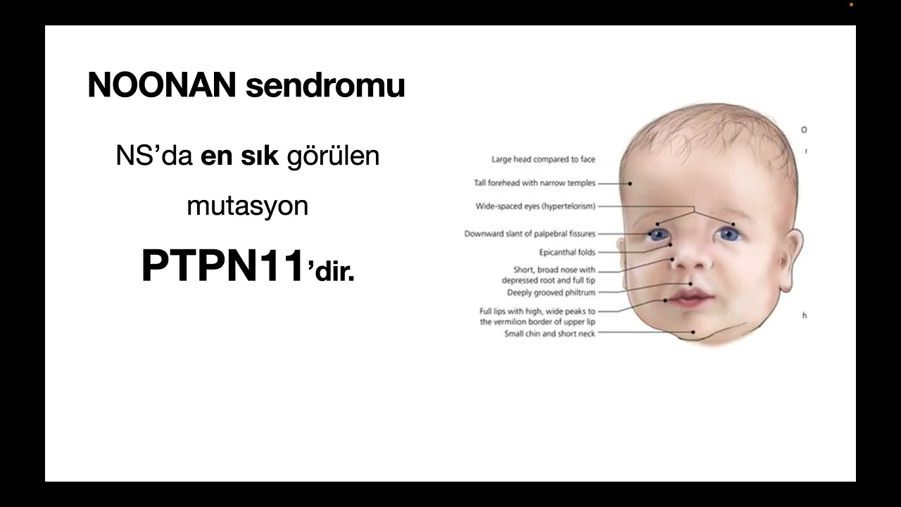Noonan sendromu, bir solukta...