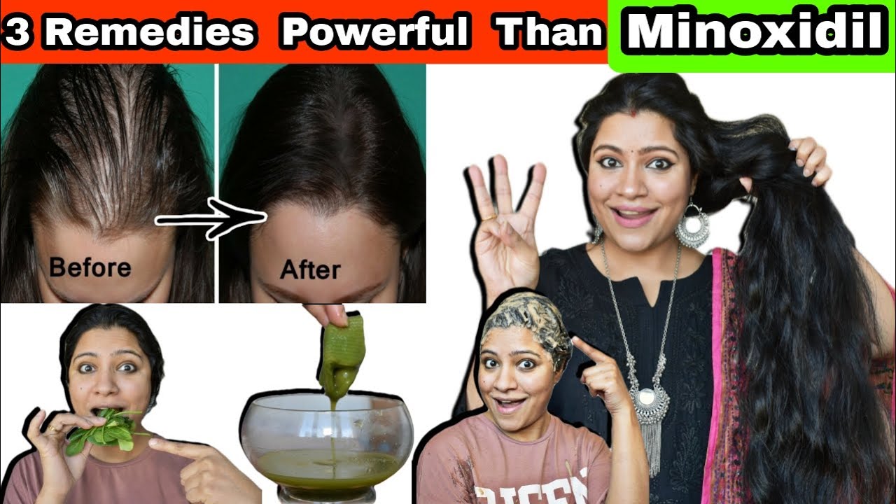 These 3 Remedies Are More Powerful Than Minoxidil To Regrow New Hair & Thick Hair Growth