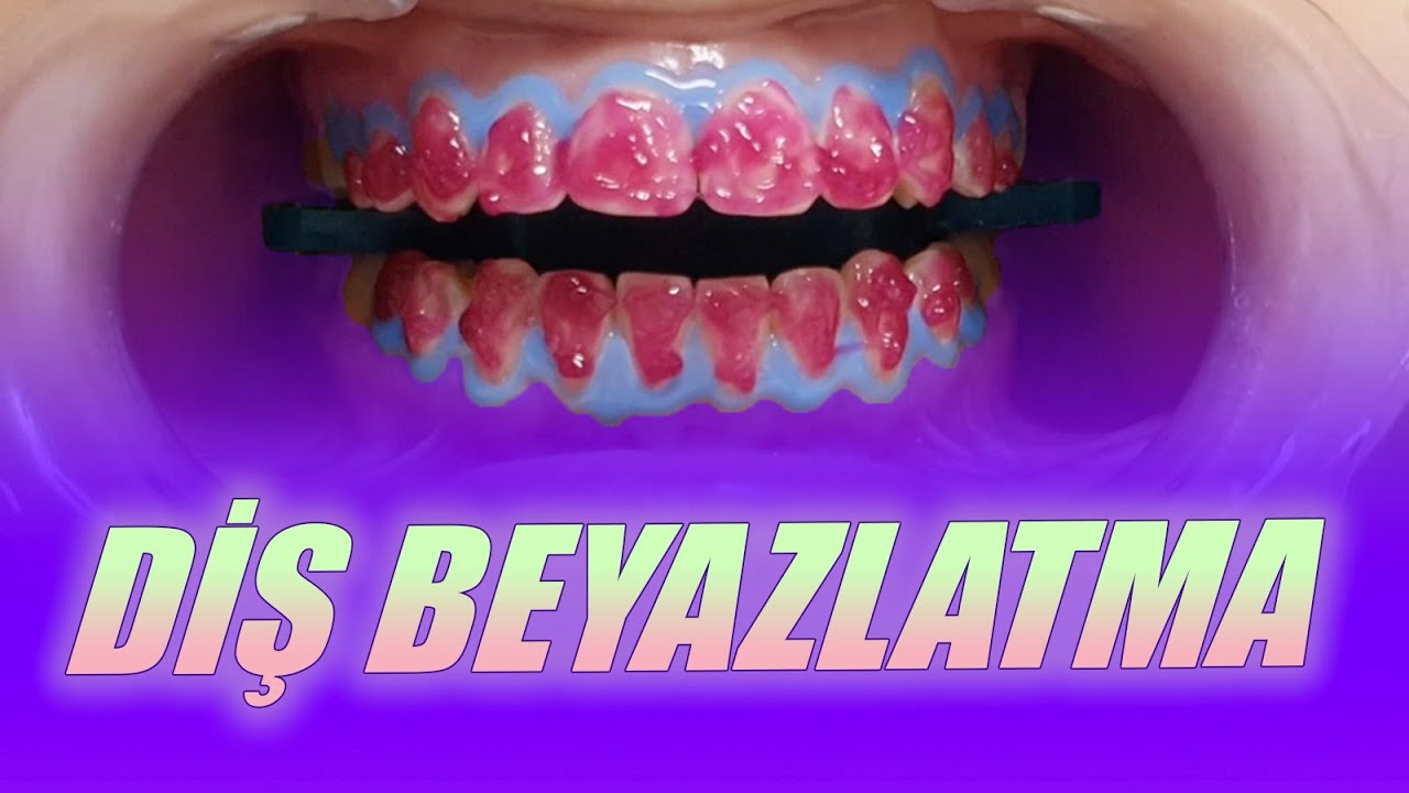 Diş Beyazlatma Nasıl Yapılır?