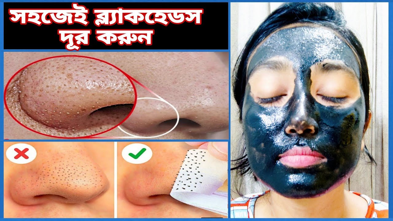 ব্লাকমাক্স ব্যবহারের সঠিক নিয়ম ! ত্বকের ব্ল্যাকহেডস দূর করুন সহজে ! Black mask use ! Honest review