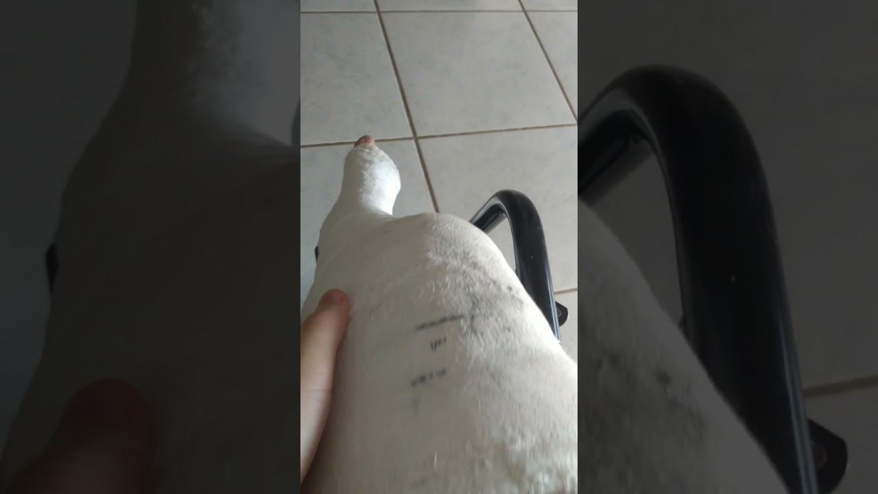 minha perna quebrada 😔😔