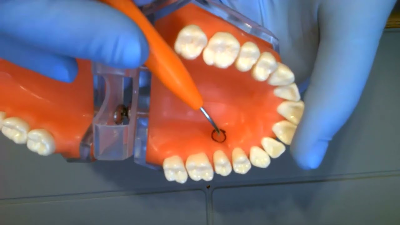Laser Technique for Treating Aphthous Ulcers and Herpetic Lesions