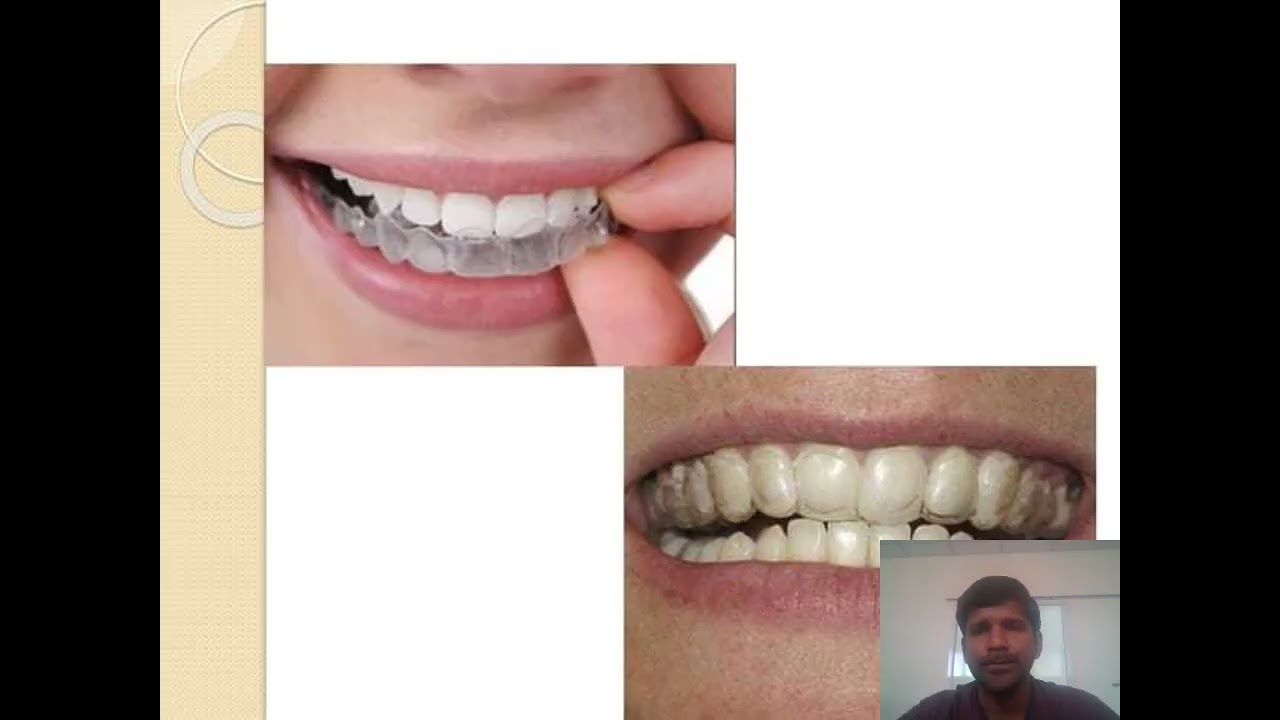 Bleaching of discoloured teeth
