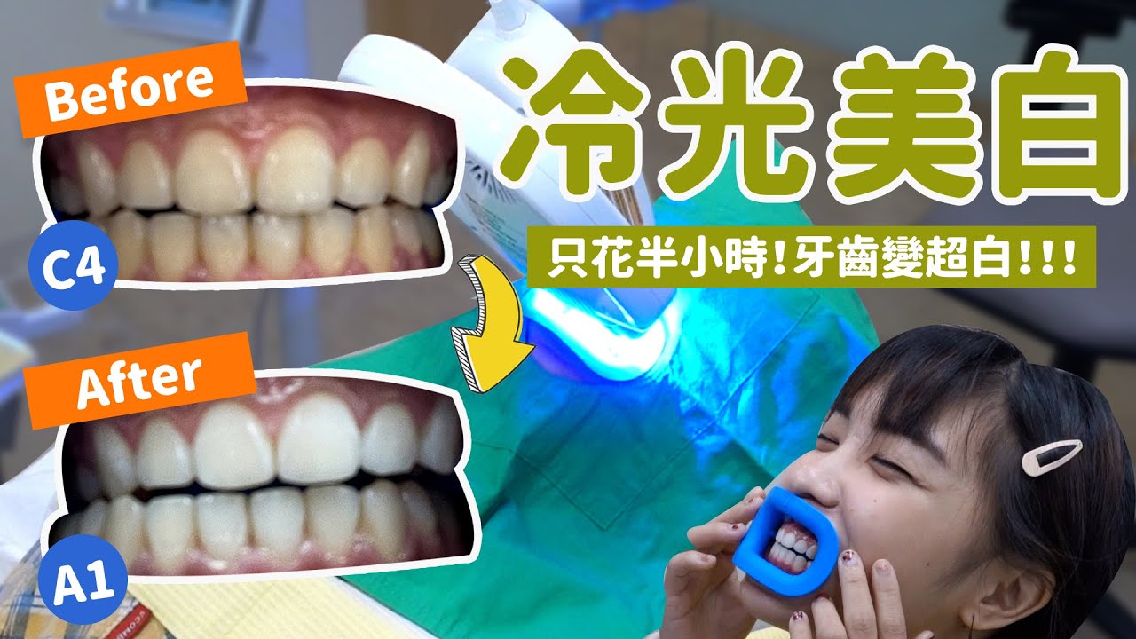 牙套日記＃最終章－牙齒半小時就變超白的魔術！冷光美白｜移動岑寶