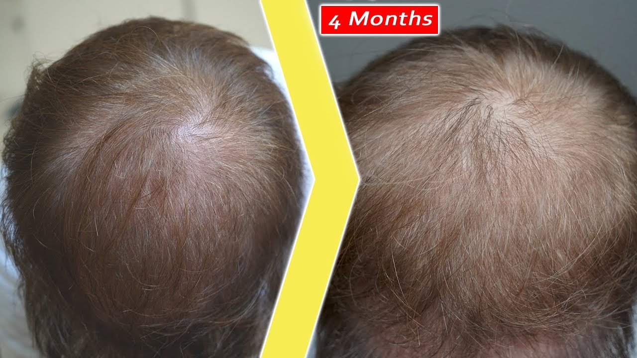 4 Months after Topical Finasteride