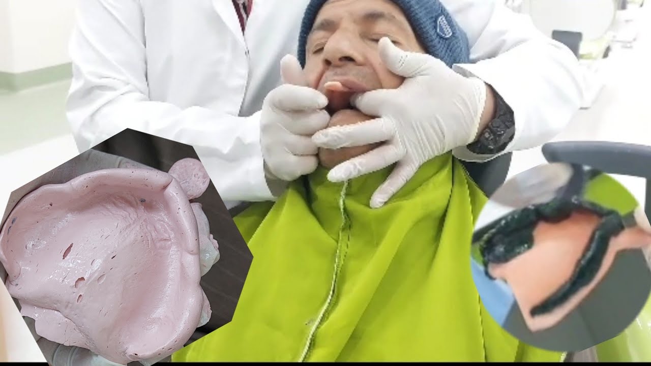 Maxillary Secondary Impression For Complete edentulous patient  شرح عملى