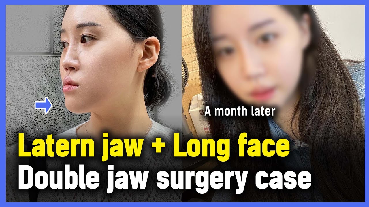 [EN/JP] (Lantern Jaw, Long face) Korean Double Jaw Surgery Case (A month later)