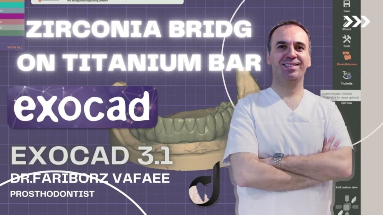 How to design zirconia bridge on titanuom bar in exocad3.1