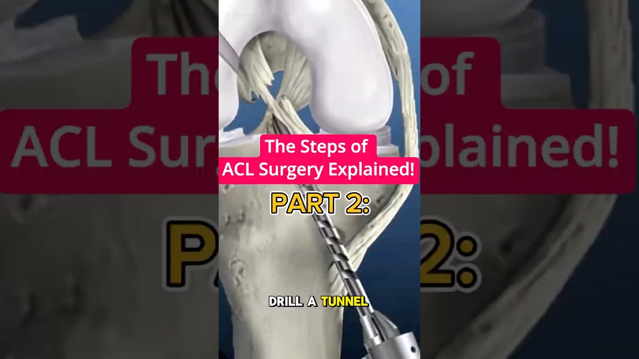 ACL Reconstruction Explained (Part 2) | Graft Fixation & Final Steps