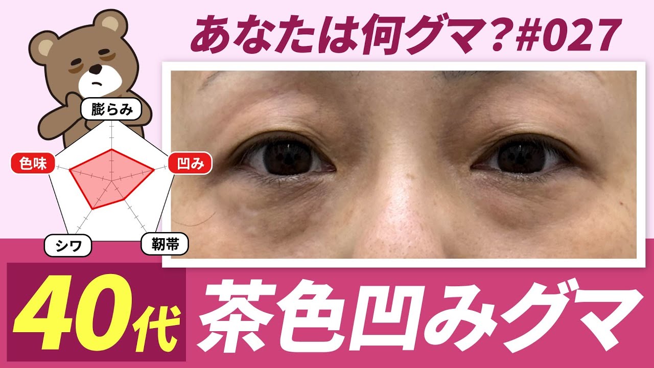 【目の下のクマ取り】強い茶グマと凹みが目立つ方のクマ取り整形症例解説！［クマ診断＃027］