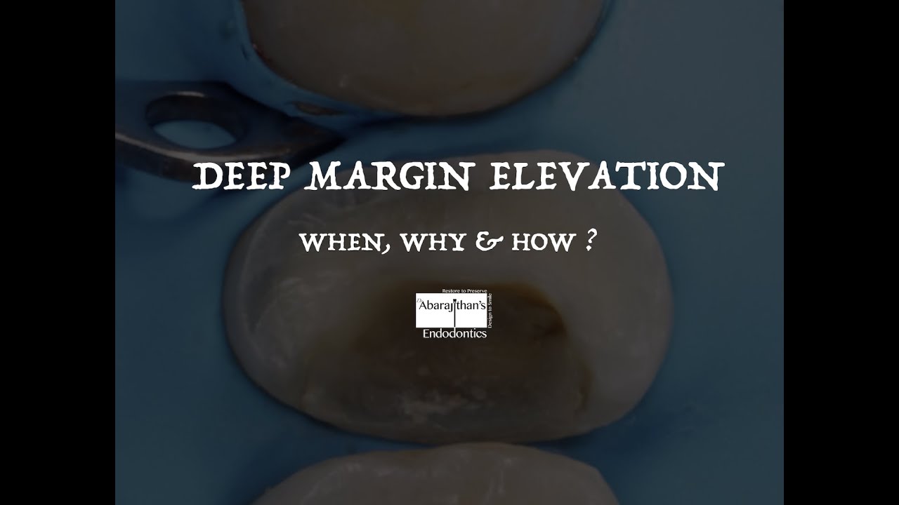 DEEP MARGIN ELEVATION - When ,Why & How ?