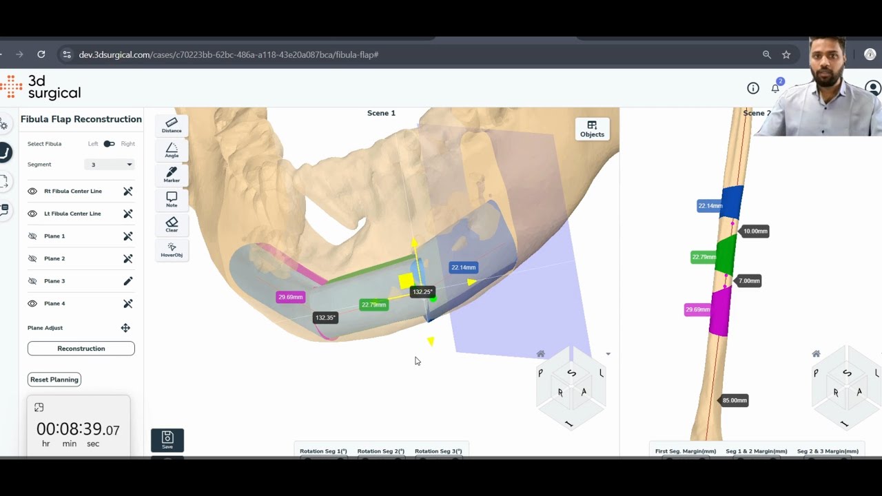 Revolutionizing Free Fibula Flap Planning: 3D Surgical Platform in Action