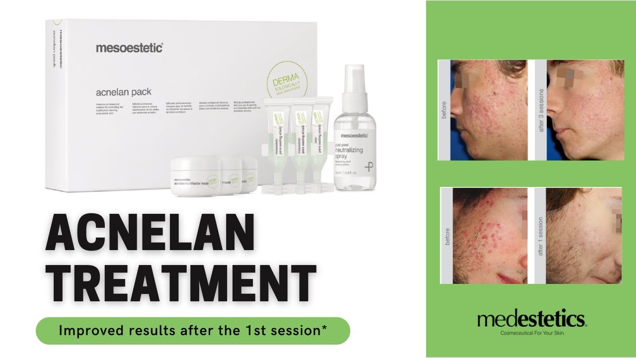 Why Acnelan is the BEST peeling for acne?