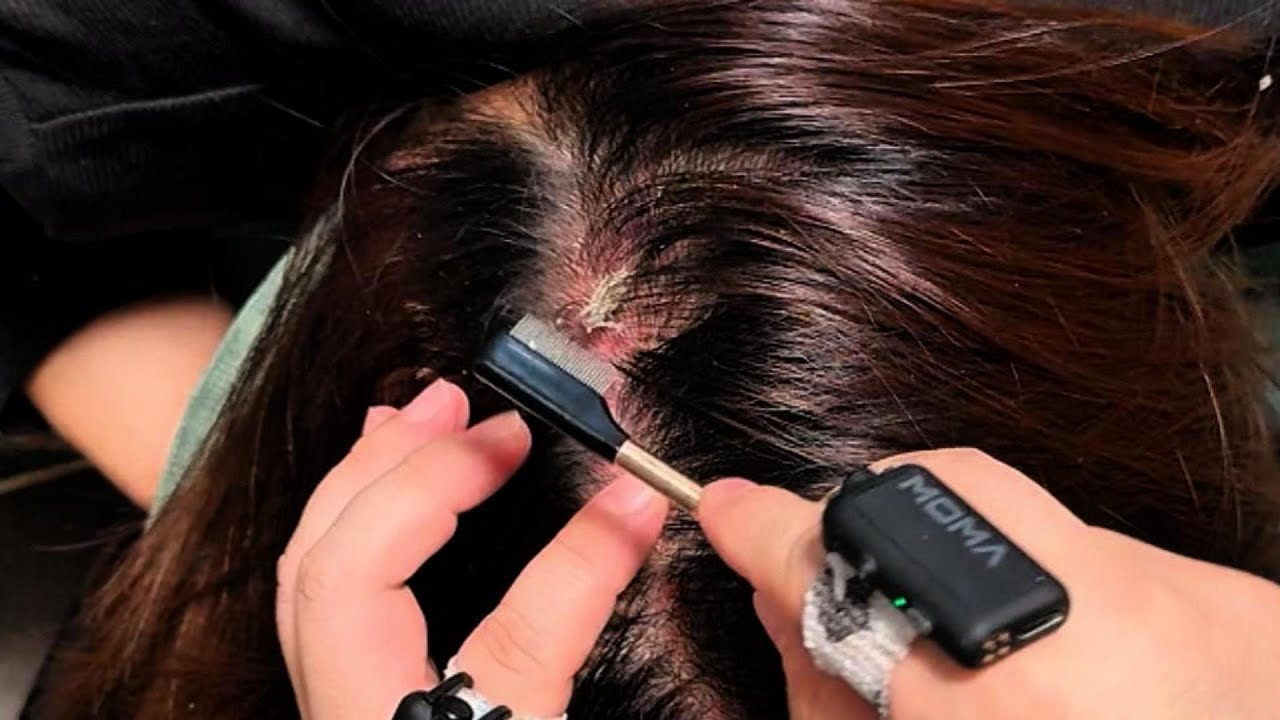 Relaxing Scalp Care ASMR with Jojo ｜ Gentle Tweezers & Fine Comb