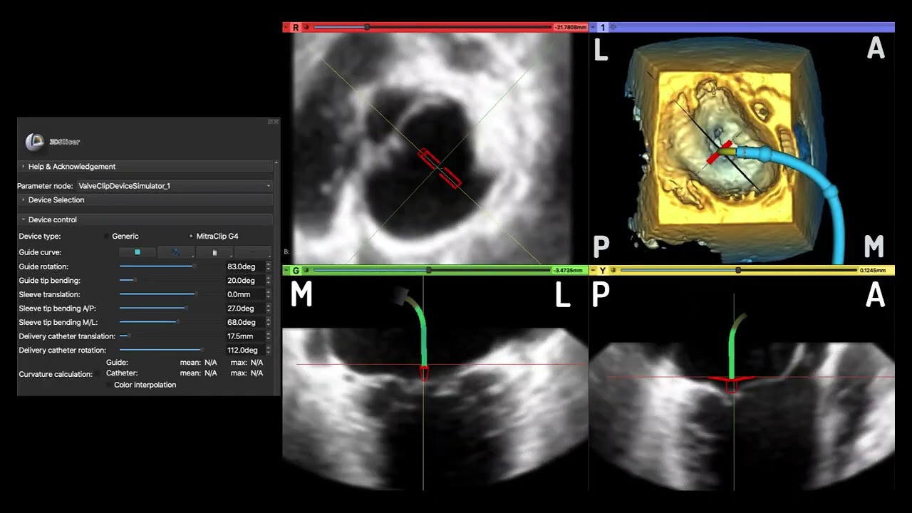 Virtual Valve Clip Modeling in 3D Echocardiogram Derived Volume Rendering Using 3D Slicer