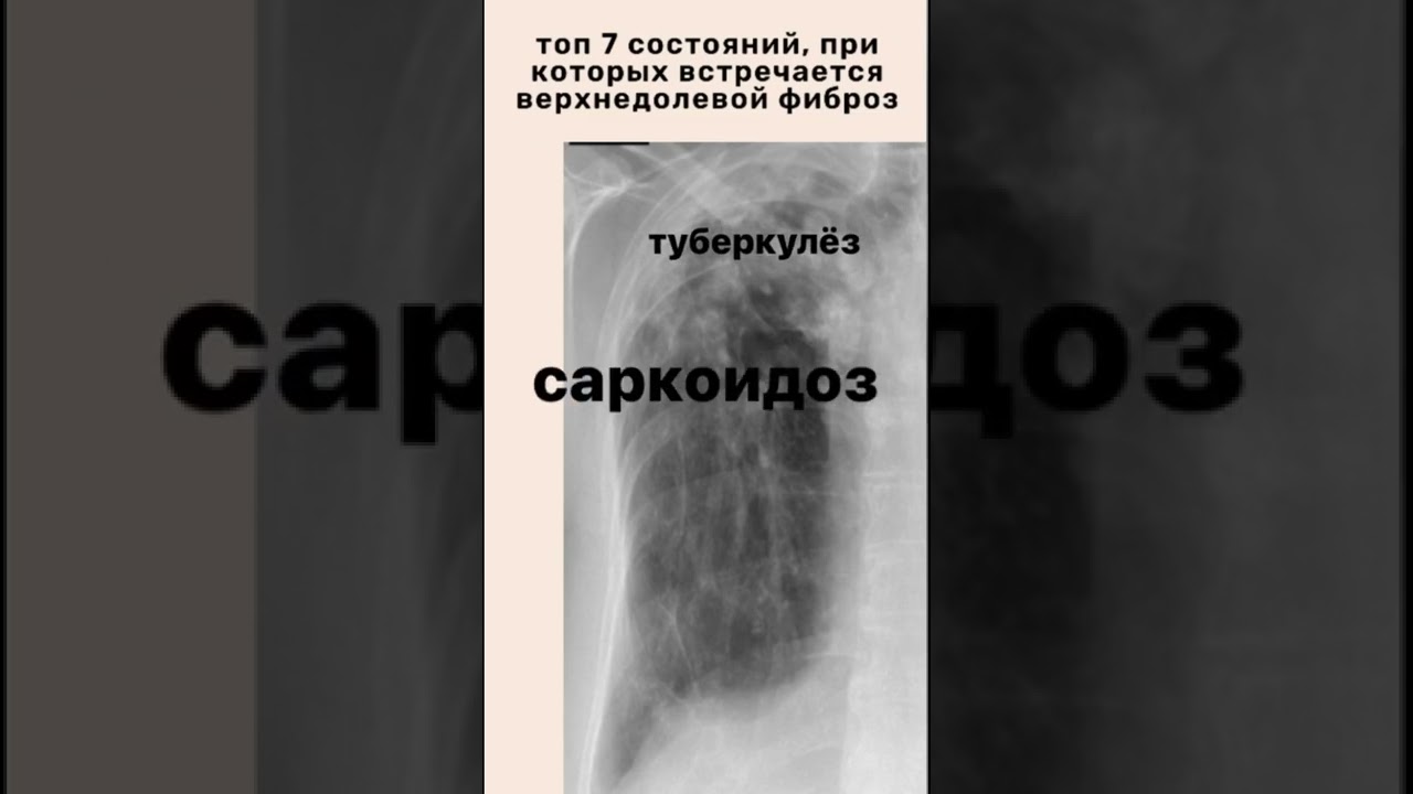 Топ -7 состояний, при которых на рентгенограмме встречается верхнедолевой фиброз