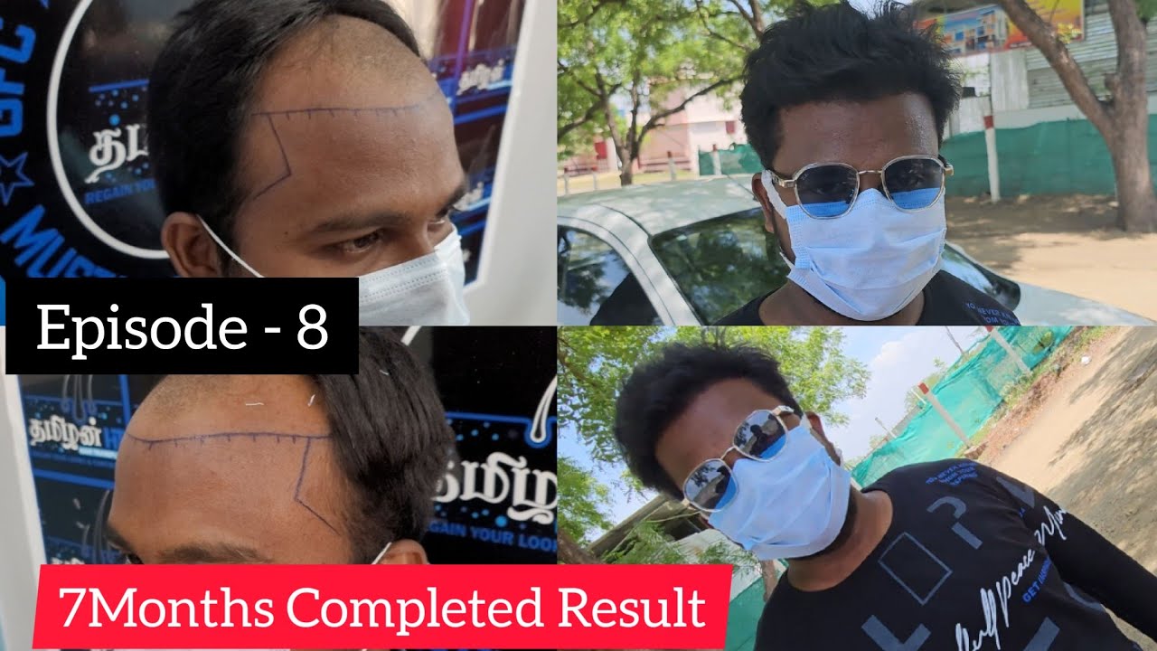 Episode -8 After Hair Transplant Results | FUE Tamil Hair Transplant | Tamilan HT