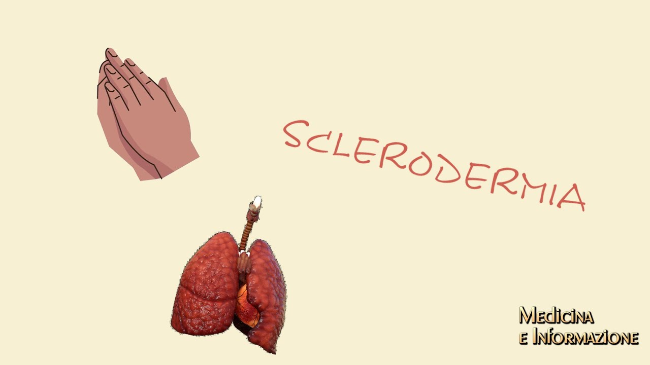 Sclerodermia: diagnosi precoce, gestione multidisciplinare e terapie per le complicanze polmonari