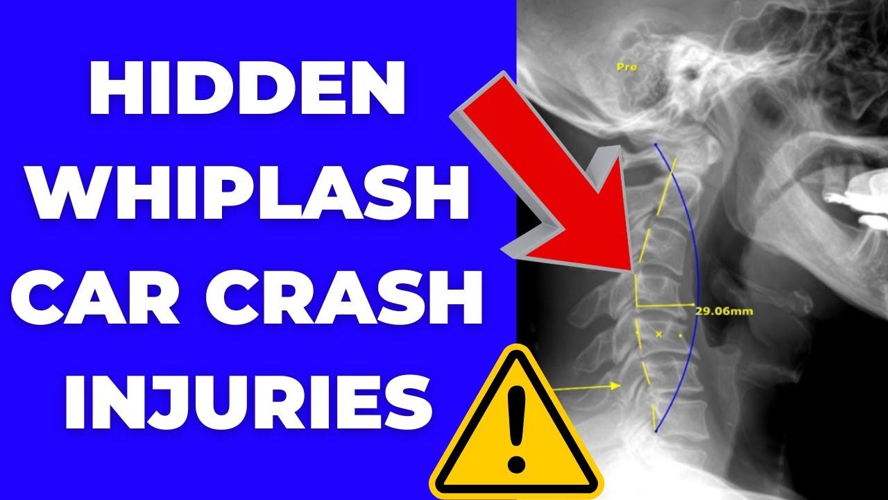 The Hidden Neck Injury After a Car Crash, WHIPLASH (Why X-Rays & MRIs Miss It!) | Dr. Gregory Kramer