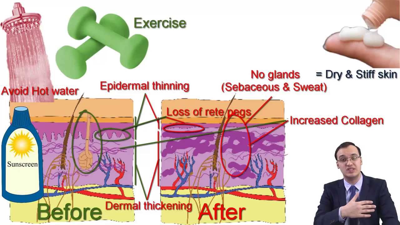 Scleroderma (Systemic sclerosis)