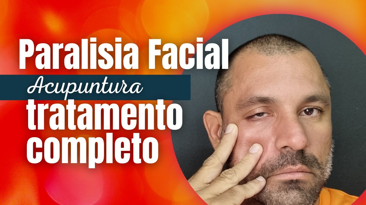 Tratamento da Paralisia facial com Acupuntura e Auriculoterapia