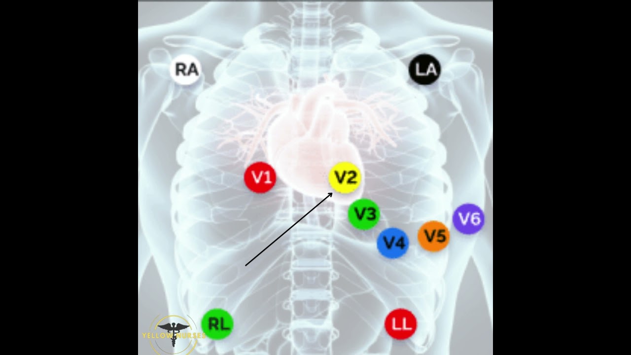 ECG PLACEMENT - 12 LEAD ECG