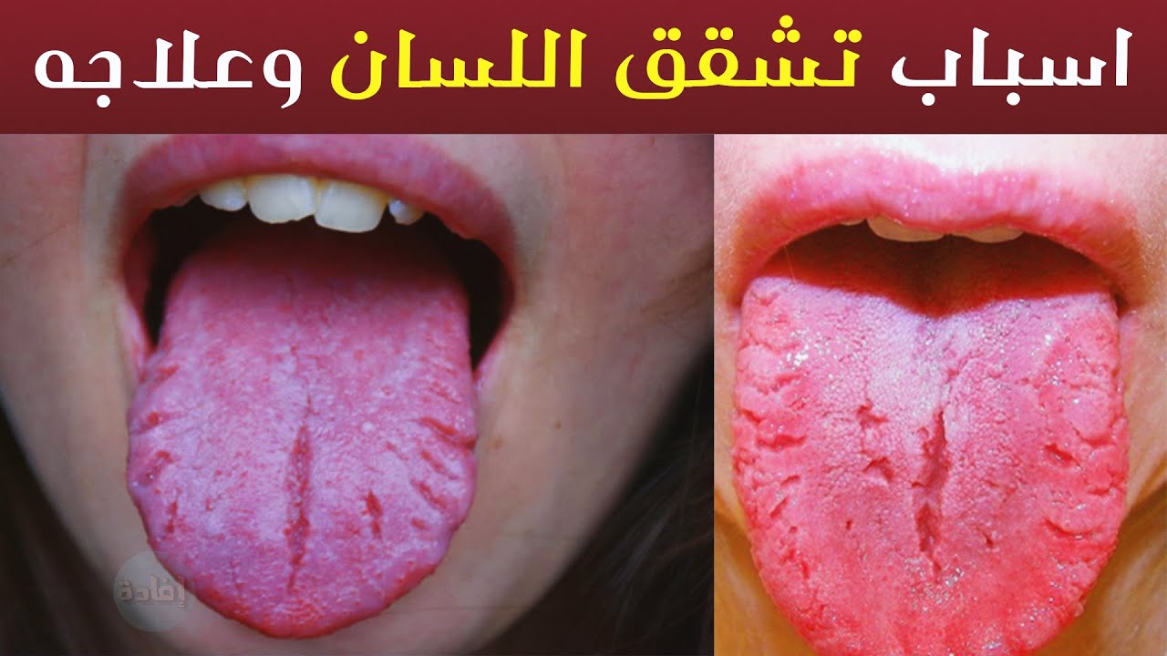 اسباب تشقق اللسان