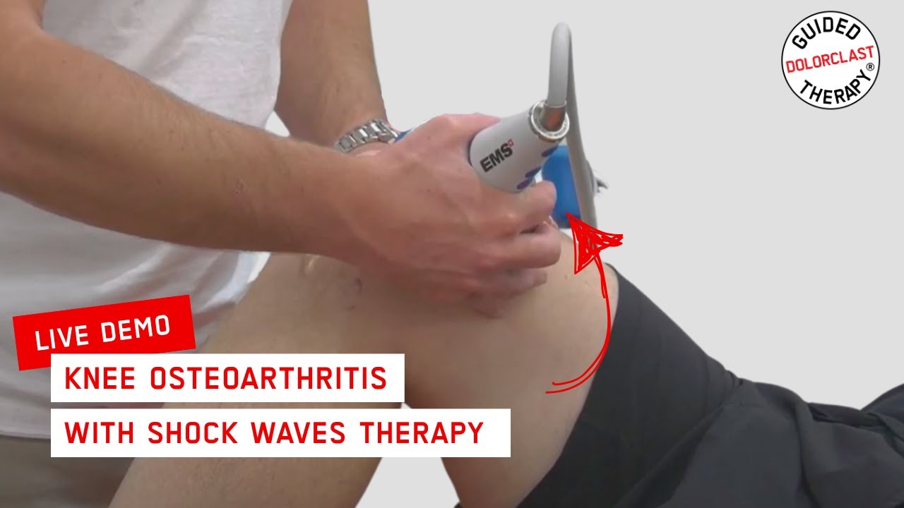 How to treat Knee Osteoarthritis with DolorClast® Shock Waves - Live Treatment by James Ferrie
