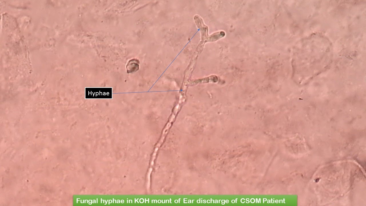 Fungal Hyphae in KOH mount of Pus discharge