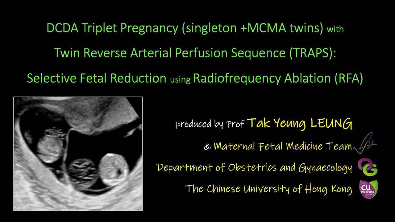 TRAPS in DCDA Triplet pregnancy reduced by RFA