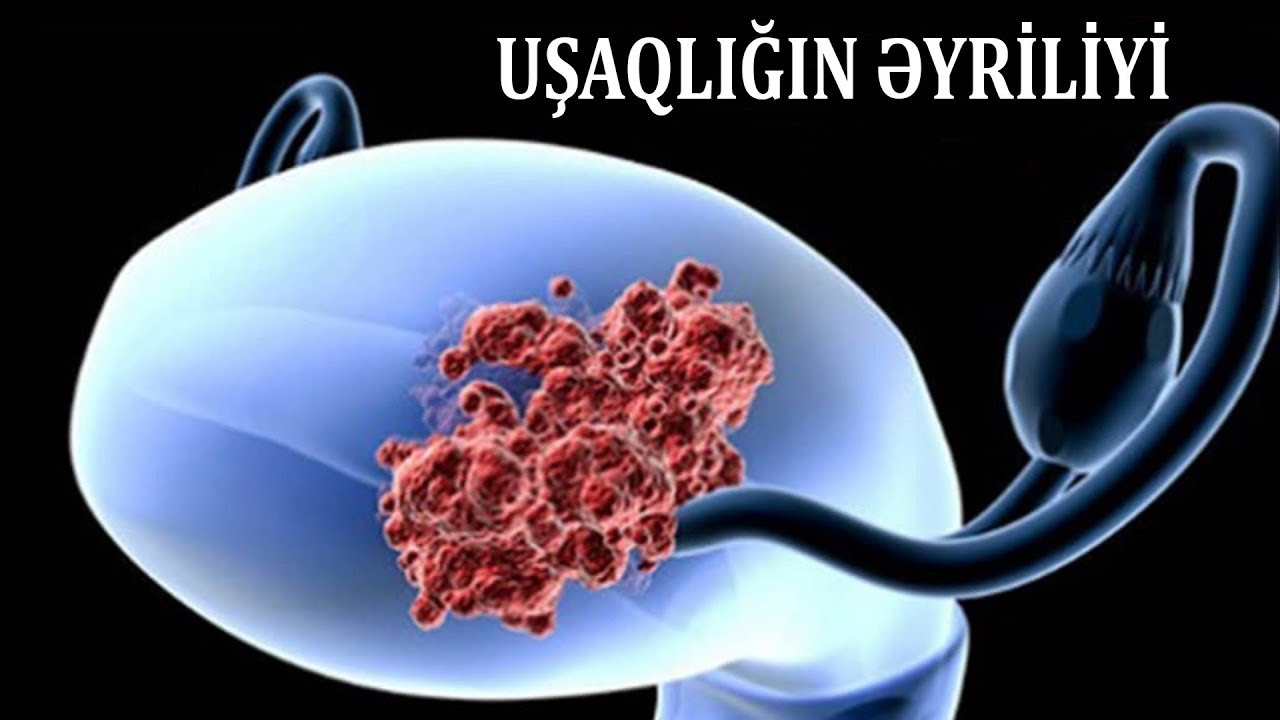 Uşaqlığın əyriliyi sonsuzluq yaradırmı?