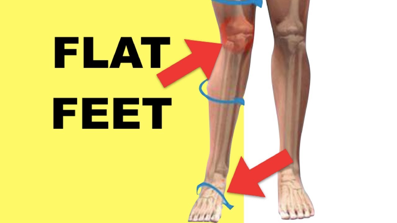 Patellar Tendonitis Exercises / Stretches - Flat Feet & Jumper’s Knee Tendonitis