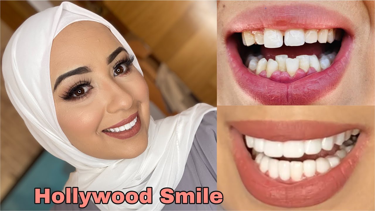 🇹🇷شحال ثمان ابتسامة هوليوودفي تركيا |Hollywood Smile 😀