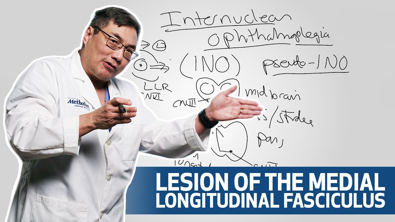 Evaluating Internuclear Ophthalmoplegia | Houston Methodist