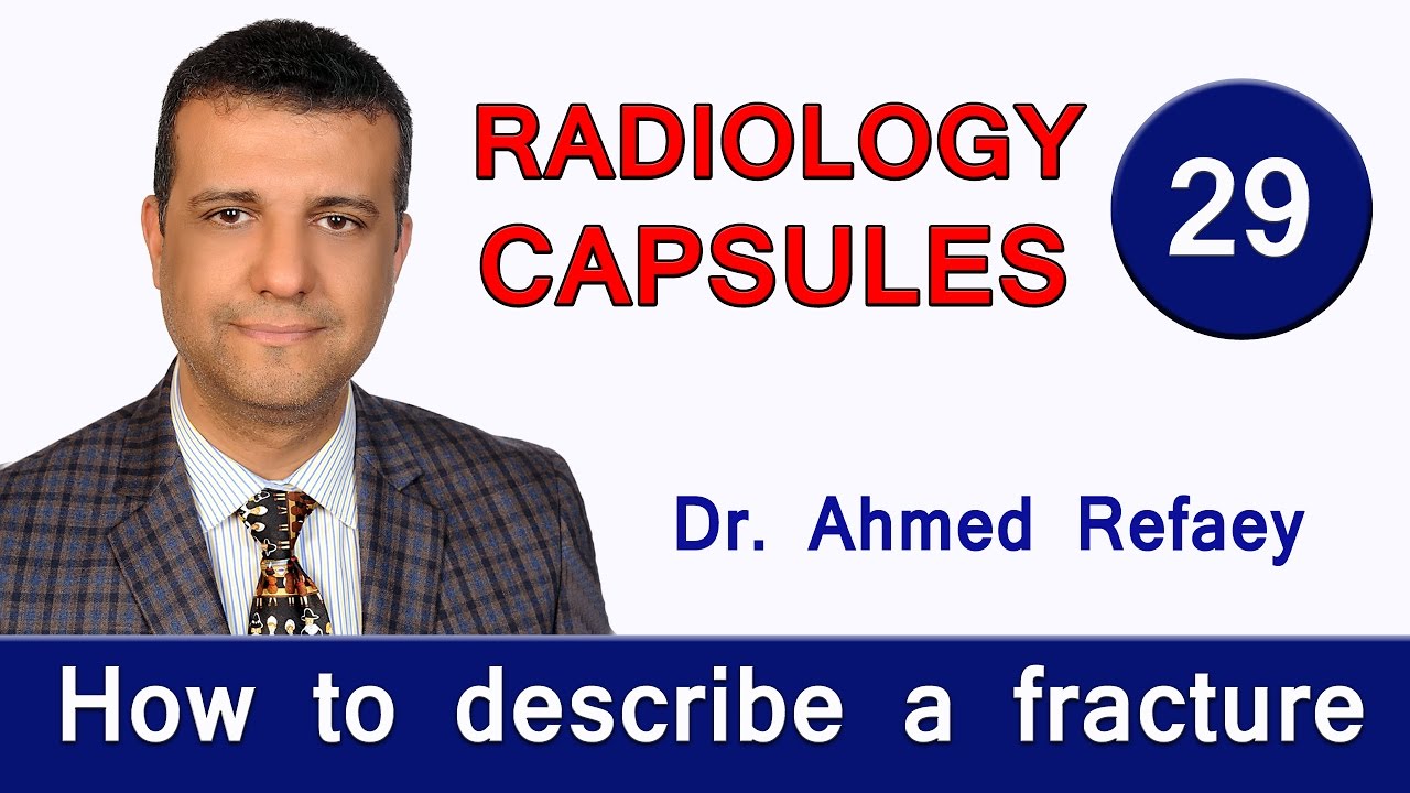 Capsule 29 : How to describe a fracture
