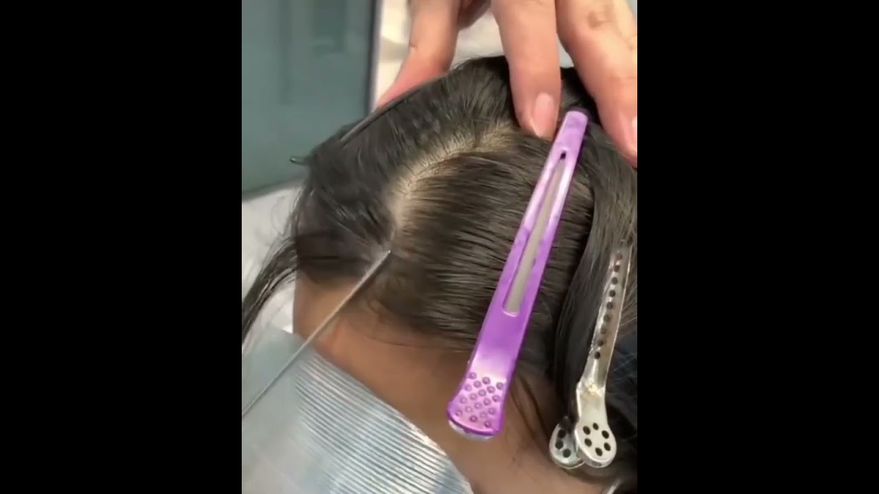 How to wear scar human hair replacement Accidental burns