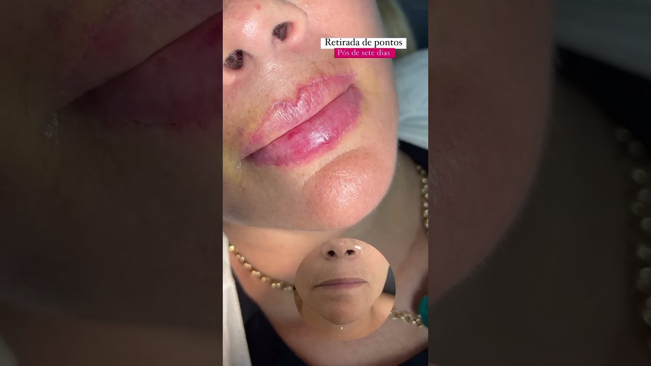 FullLipLifting , resultado definitivo pela Dra  Scarlett Sampaio.
