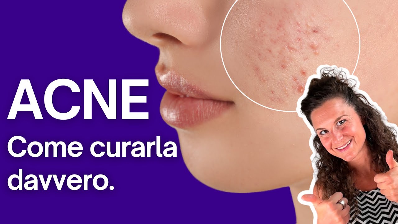 ACNE: come risolverla davvero (soluzioni pratiche)