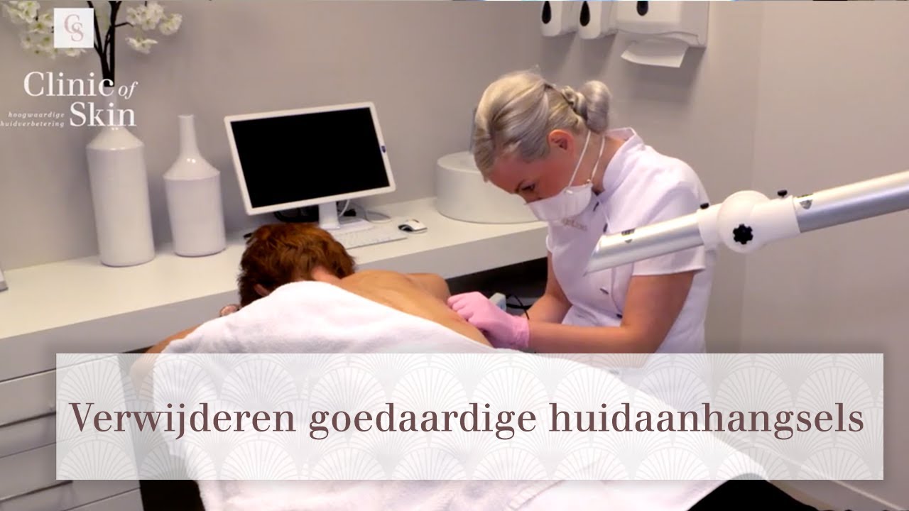 Verwijderen goedaardige huidaanhangsels d m v  coagulatietherapie, laser en stikstof