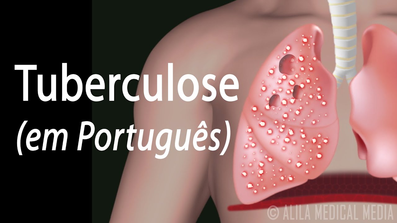 Tuberculose: Infecção Latente e Doença Ativa, Animação. Alila Medical Media Português