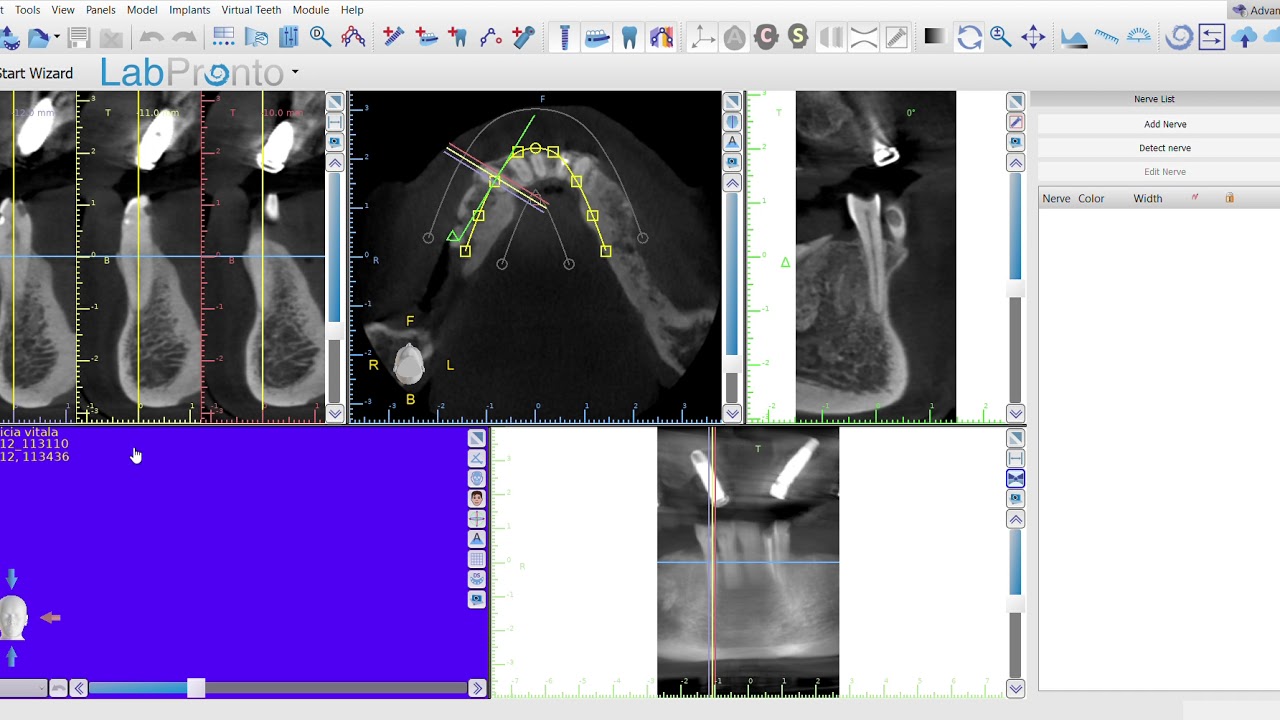 How to process the DICOM file in to Blue Sky Planner. Dr. Omid Termechi