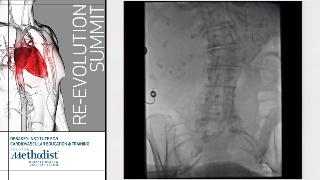 Catheter Skills for the Cardiac Surgeon: Catheters, Wire, Approaches, Pitfalls (Neal Kleiman, MD)
