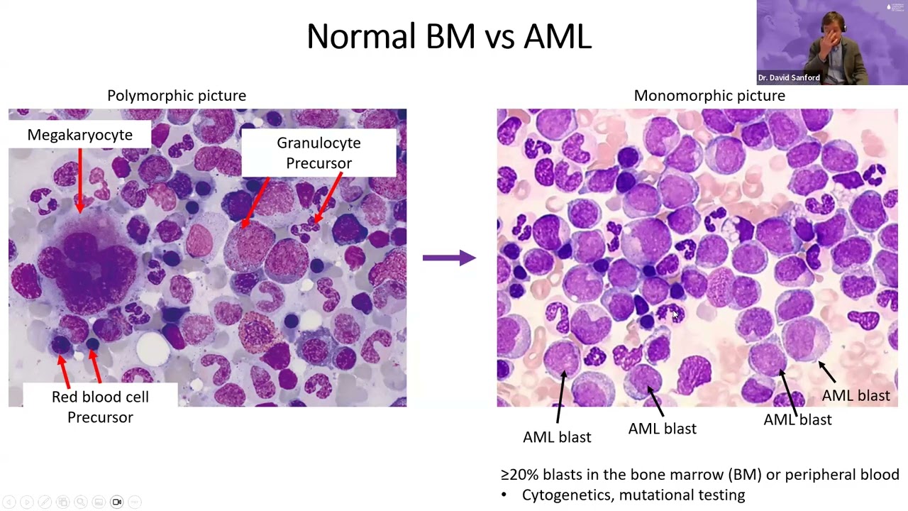 Caring for Older Adults with AML: Navigating the Canadian Algorithm and Enhancing Nursing Support