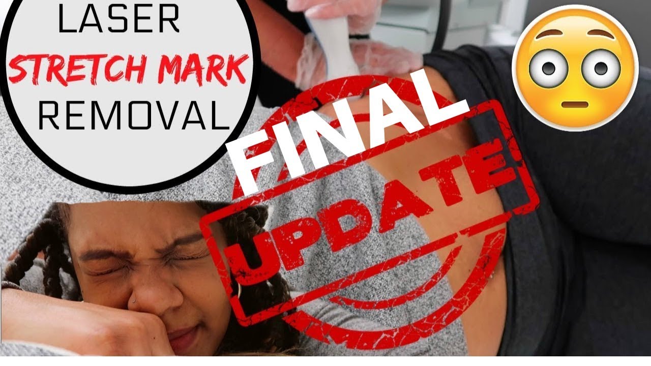 FINAL LASER STRETCH MARK REMOVAL UPDATE!